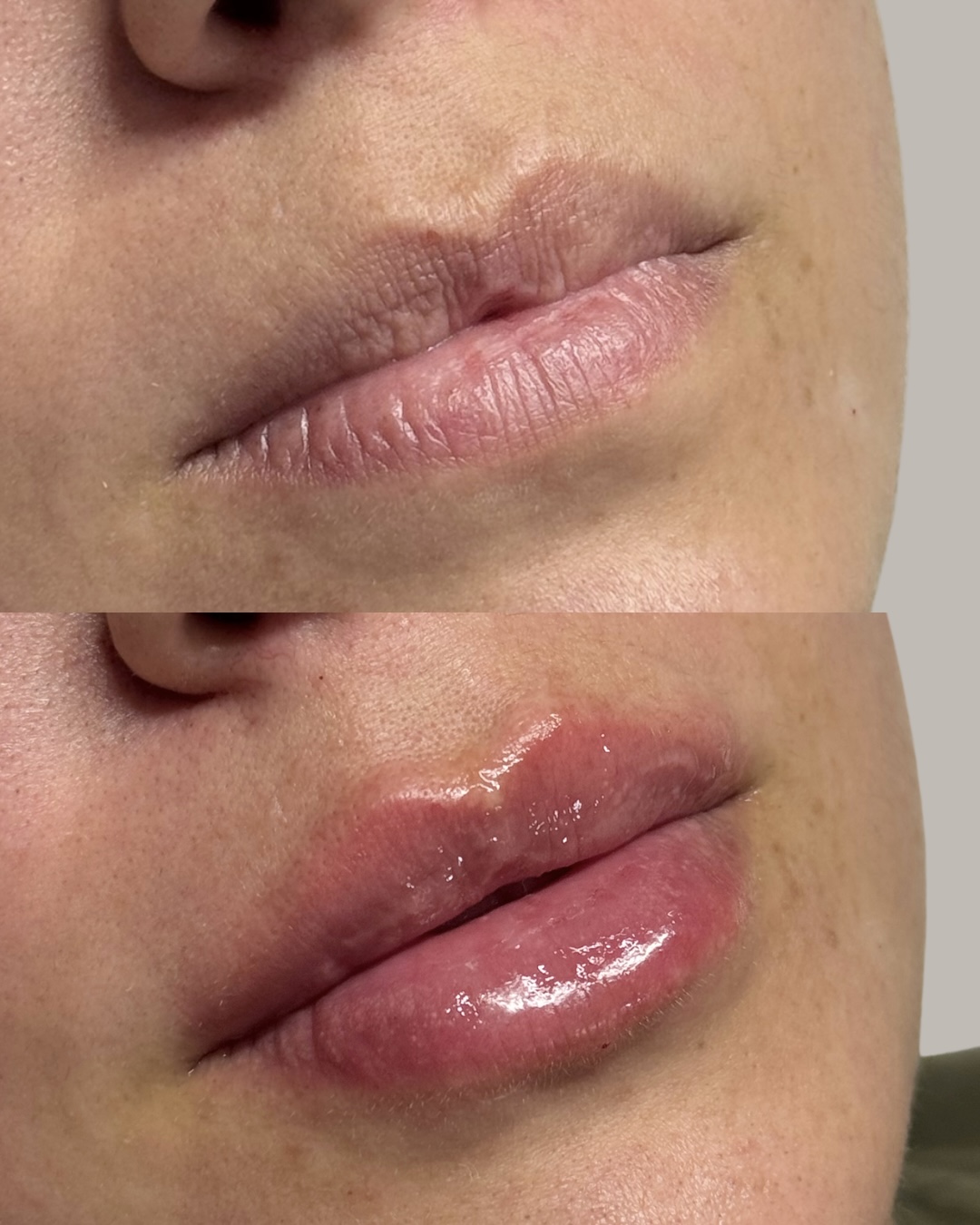 Resultado de antes e depois de preenchimento labial
