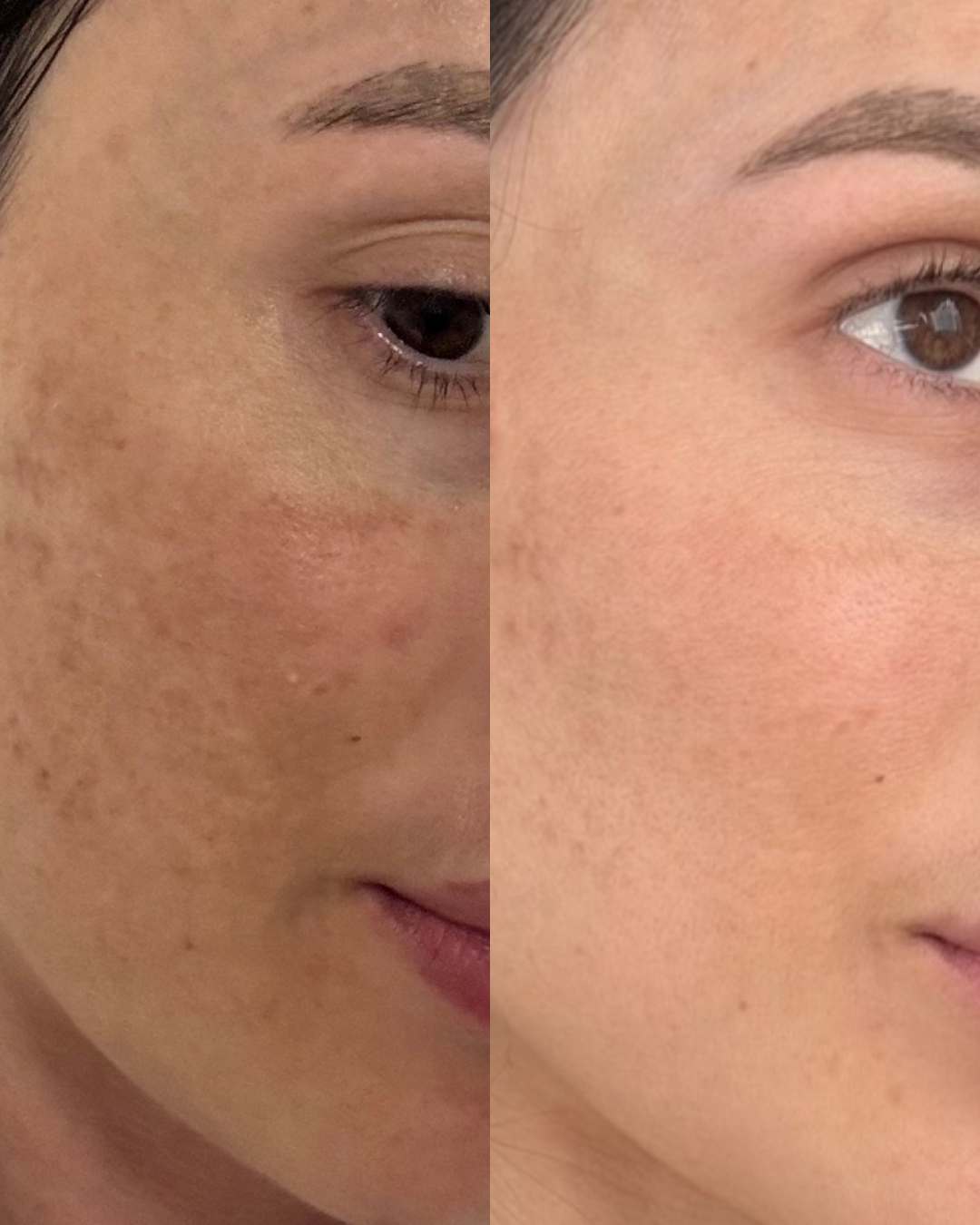 Resultado de antes e depois do cuidado com a pele