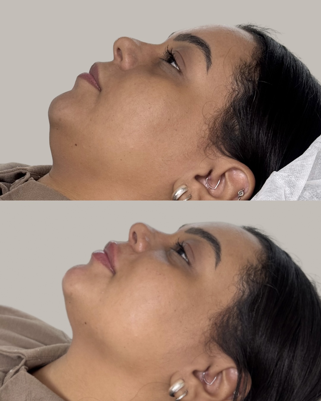 Resultado de antes e depois de harmonização facial em perfil