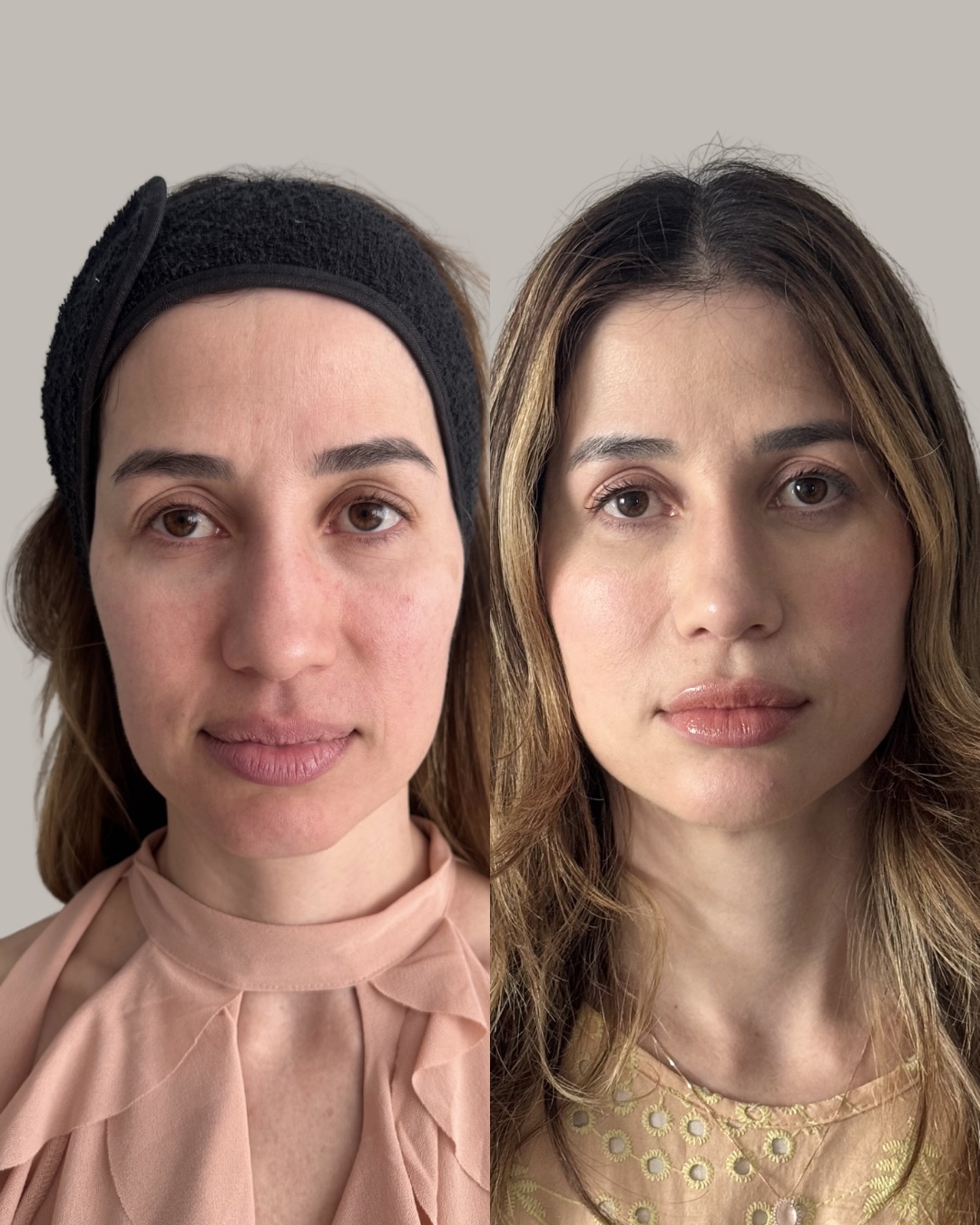 Resultado de antes e depois de harmonização facial