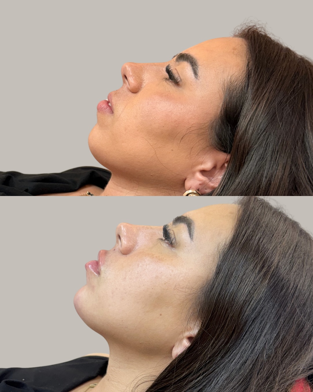 Resultado de antes e depois de harmonização facial em perfil