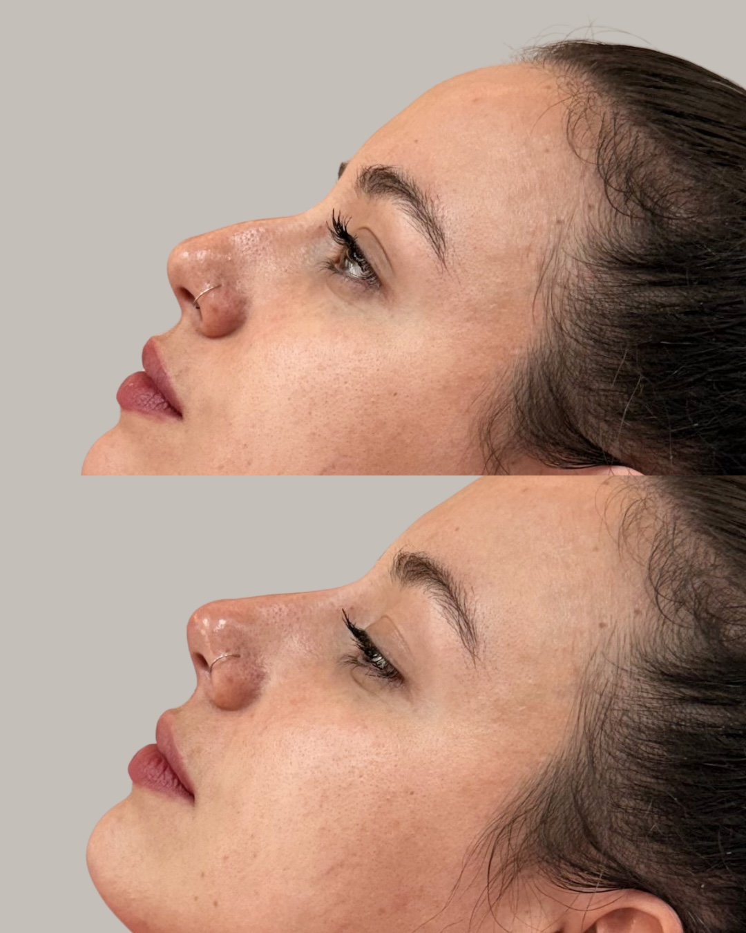 Resultado de antes e depois de harmonização facial em perfil