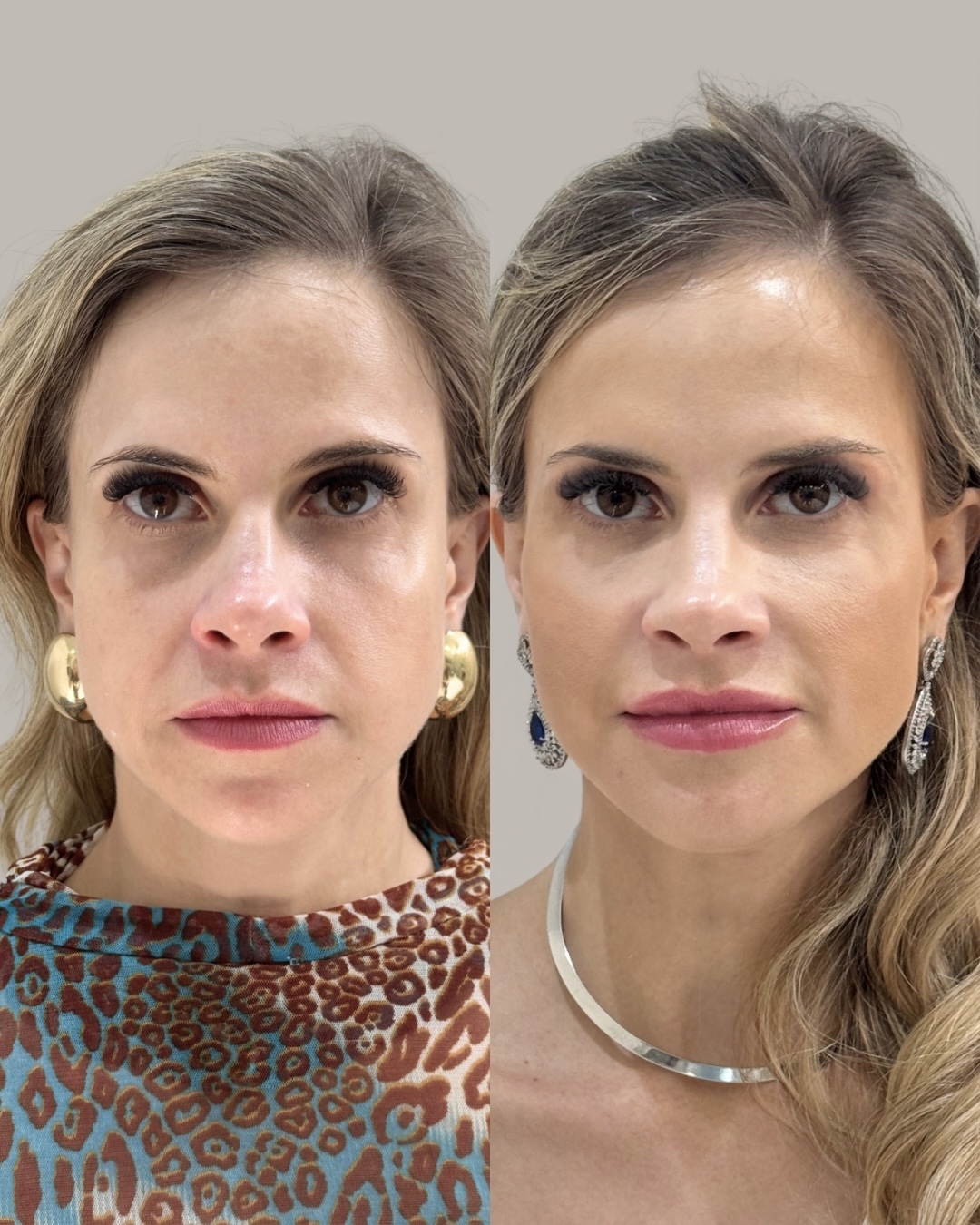 Resultado de antes e depois de tratamento facial