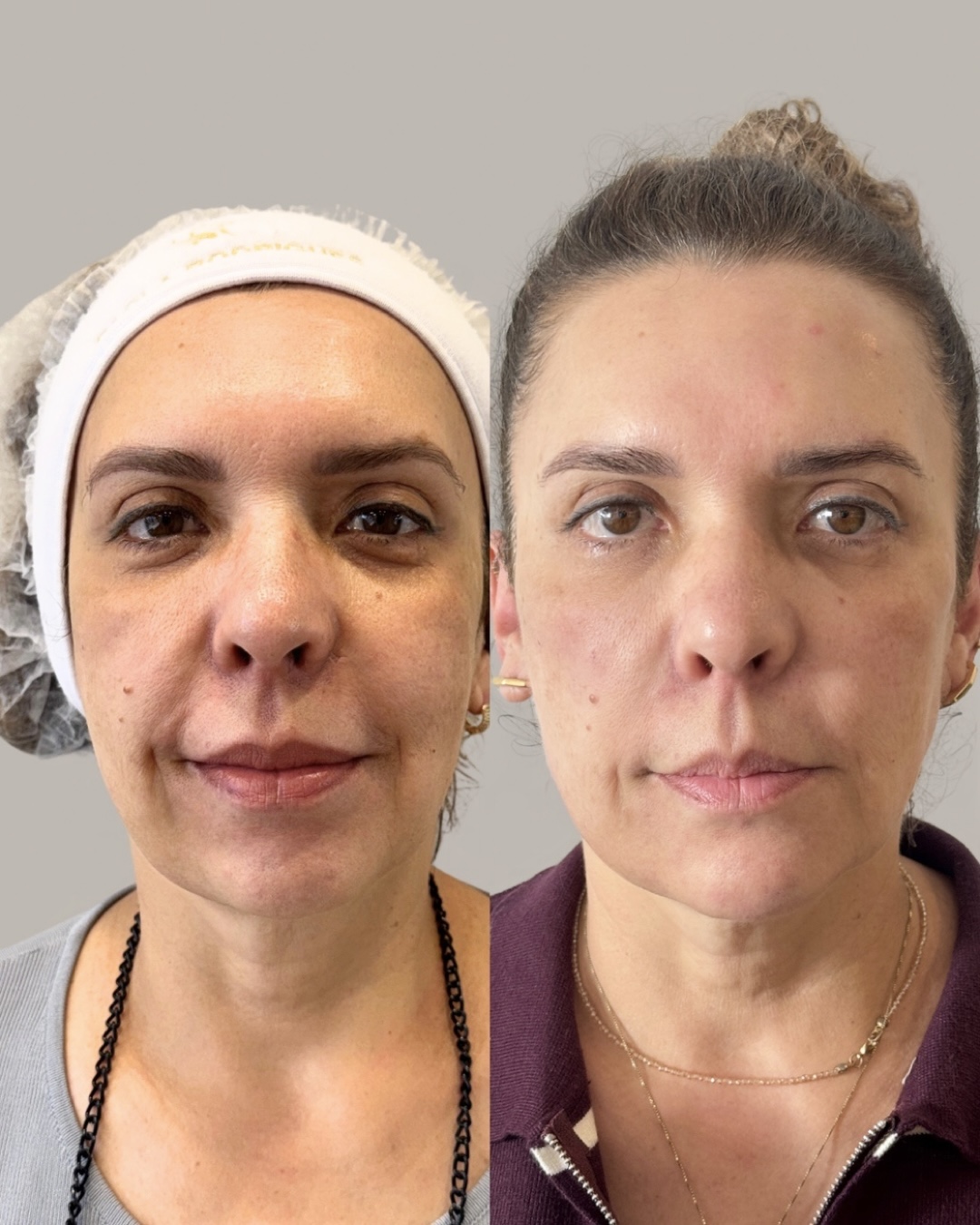 Resultado de antes e depois de tratamento facial